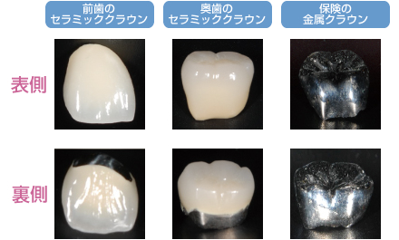 クラウン(冠)