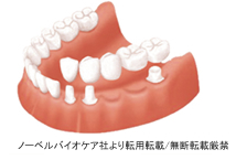 ブリッジ治療